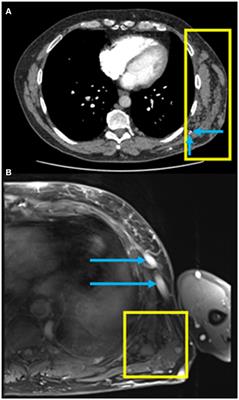Chronic thromboembolic pulmonary hypertension secondary to a vascular malformation: case report diagnosis by lung subtraction iodine mapping